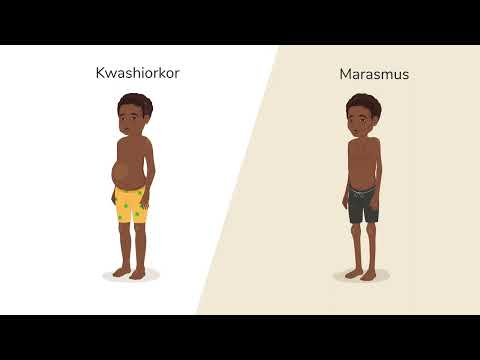 Understanding Malnutrition: Key Symptoms and Effective Treatments