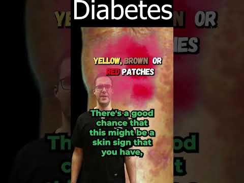 Understanding Necrobiosis Lipoidica Diabeticorum Symptoms and Care