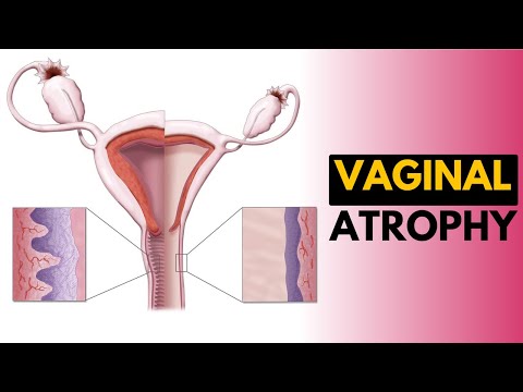 Understanding Postmenopausal Atrophic Vaginitis Symptoms and Care