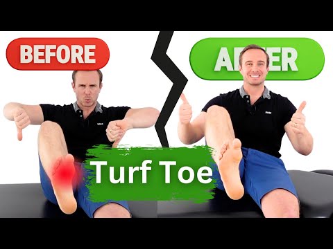 Turf Toe: Recognizing Symptoms and Finding Relief