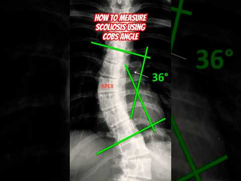 Understanding Cobb Angle Measurements for Scoliosis Care