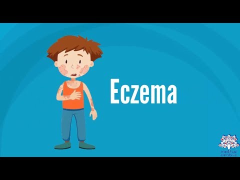 Understanding Allergic Eczema: Causes, Symptoms, and Care