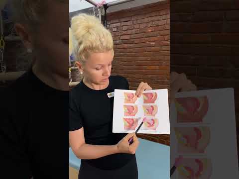Understanding Pelvic Organ Prolapse: Causes and Symptoms
