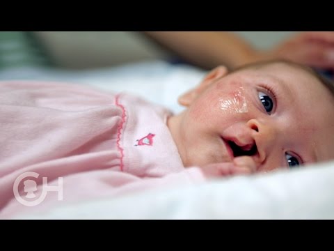 Understanding Cleft Lip and Palate: Stories and Insights