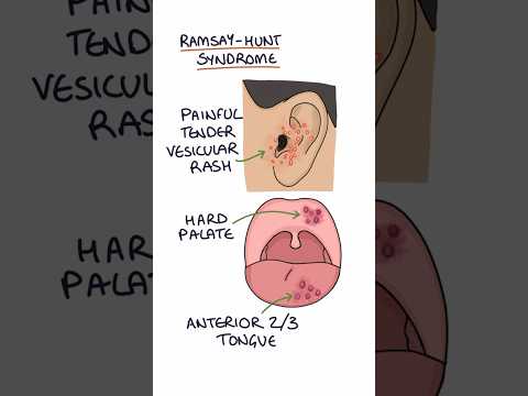 Ramsay Hunt Syndrome: Symptoms, Causes, and Healing Paths