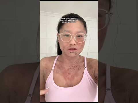 Eczema Relief: Finding Comfort in Your Skin Again