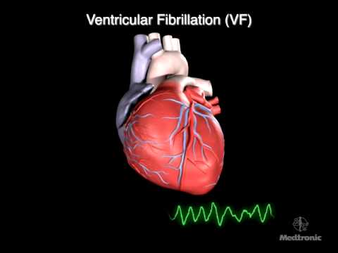 Understanding Ventricular Fibrillation: A Heart's Distress Signal