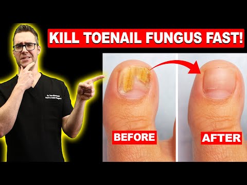 10 Home Remedies for Fungal Infections in Toenails
