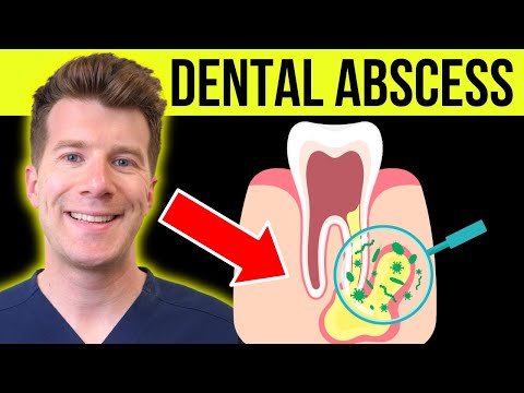 Understanding Abscess: Symptoms, Causes, and Treatment Options