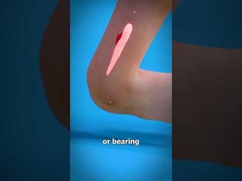 Understanding Sprained Ankle: Symptoms and Recovery Steps