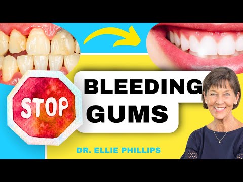 10 Effective Home Remedies for Gingivitis Relief post thumbnail image