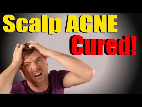 Effective Ways to Care for Scalp Pimples and Irritation