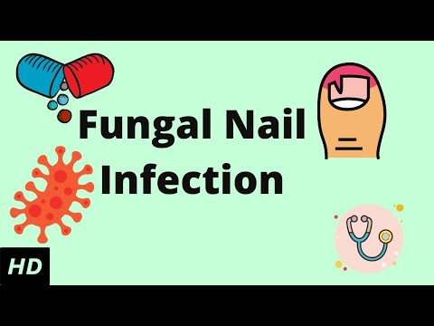 Fungal Nail Infections: Key Symptoms, Causes, and Treatments