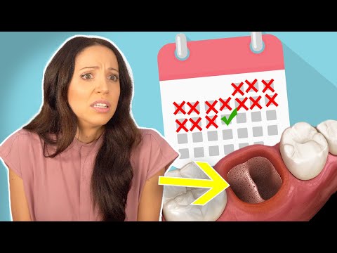 How Long Does It Take for a Tooth Extraction Hole to Heal?