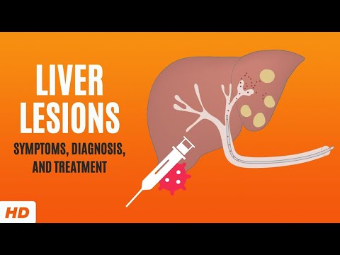 Understanding Liver Lesions: Symptoms, Causes, and Treatments