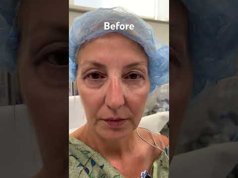 Understanding Upper Blepharoplasty: Insights and Results