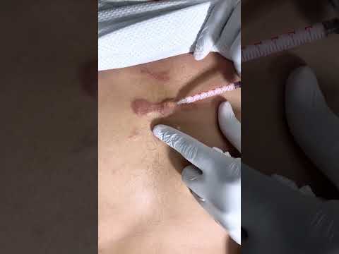 Seven Key Do's and Don'ts for Keloid Removal Success