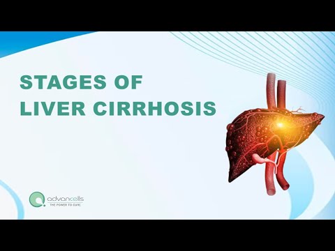 Understanding Cirrhosis: Life Expectancy and Health Tips