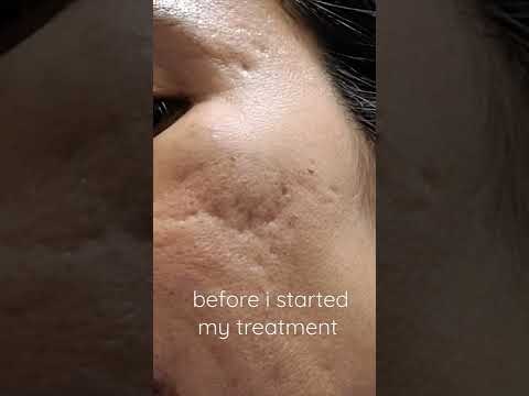 Transform Your Skin with a DIY Dermarolling Journey