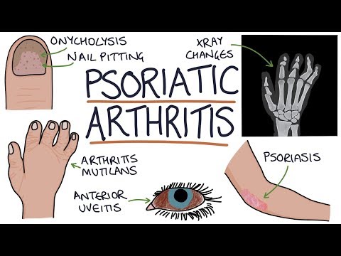 Understanding Psoriatic Arthritis in Your Hands and Nails