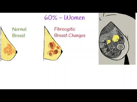 Understanding Fibrocystic Breast Changes: Symptoms and Care