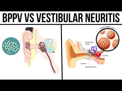 Understanding Vestibular Neuritis: Symptoms and Causes