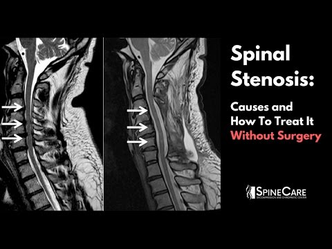 Understanding Effective Treatments for Spinal Stenosis Care