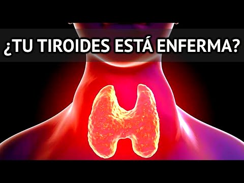 10 Señales y Síntomas que Indican Hipotiroidismo