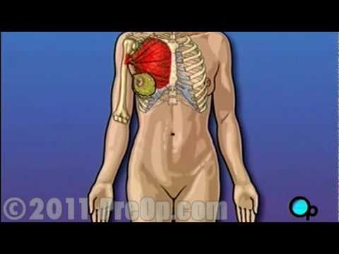 Understanding Modified Radical Mastectomy: What to Expect