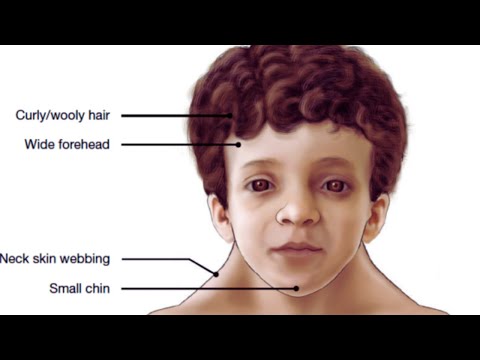 Understanding Noonan Syndrome: Signs and Symptoms in Kids