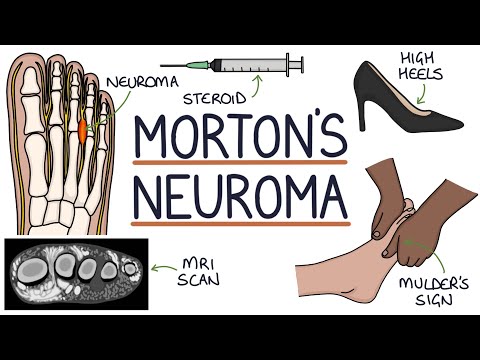 Understanding Morton’s Neuroma: Symptoms and Treatment Options