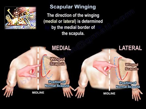 Understanding Scapular Winging: Symptoms and Treatment Options