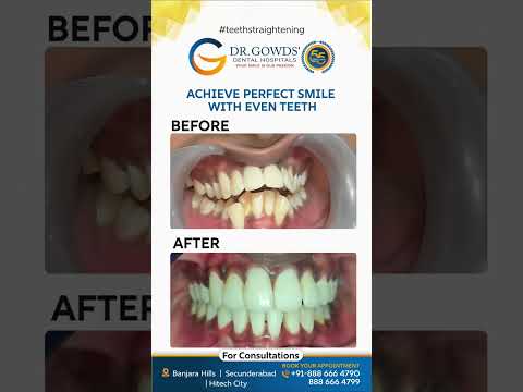 Transform Your Smile: The Truth About Crooked Teeth and Bites