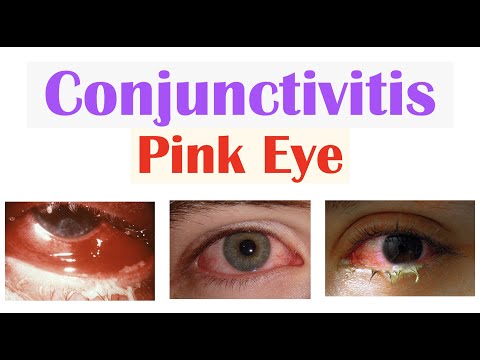 Effective Treatments for Pink Eye: A Complete Overview