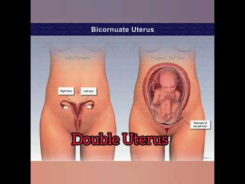 Double Uterus: Symptoms, Pregnancy Journey, and Treatment Options