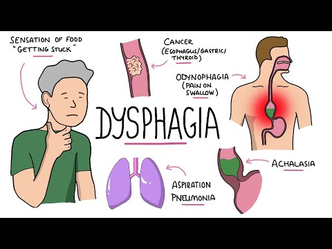 Understanding Oropharyngeal Dysphagia: Symptoms and Solutions