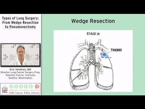 Pneumonectomy for Lung Cancer: What You Need to Know post thumbnail image