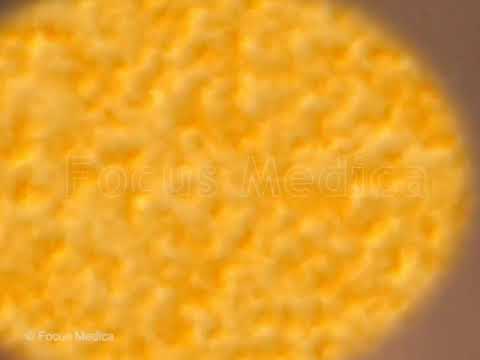 Understanding Pseudoangiomatous Stromal Hyperplasia (PASH)