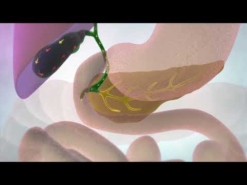 Understanding Bile Duct Drain: Purpose and Effectiveness Explained post thumbnail image