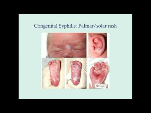 Understanding TORCH Syndrome: Diseases and Treatment Insights