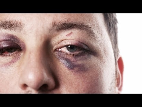 Effective Ways to Treat a Black Eye at Home