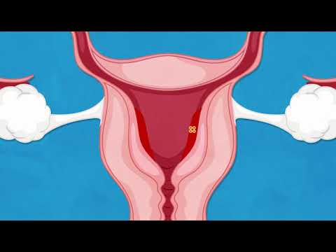 Mifepristone Oral: Uses, Side Effects, and Interactions Revealed