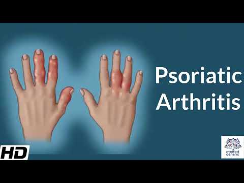Understanding DIP Psoriatic Arthritis: Symptoms and Treatments