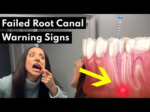 Understanding Pain After Root Canal: Signs and When to Call