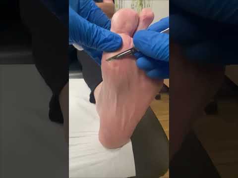 Say Goodbye to Corns: 9 Effective Removal Methods post thumbnail image