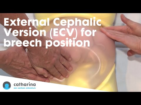 Understanding External Cephalic Version (ECV) for Breech Births