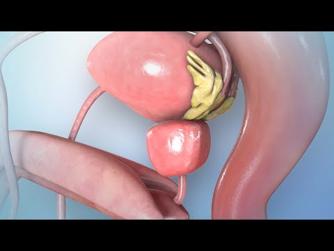 Understanding BPH: Causes and Effects of an Enlarged Prostate