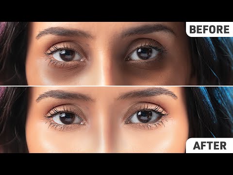 Banishing Dark Circles for Good: Fresh Eyes Ahead