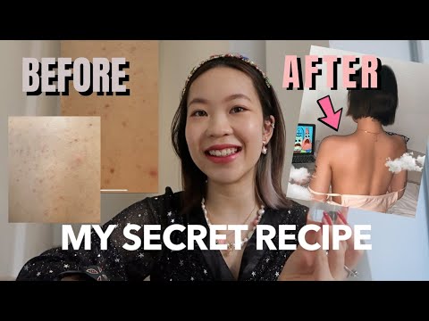 Effective Treatments for Body Acne on Your Back, Chest, and Butt post thumbnail image
