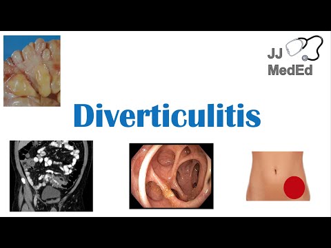 Understanding Diverticulitis: Causes and Risk Factors Explained